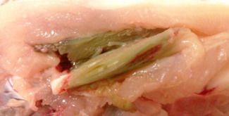 Miopatia pectorala profunda 2