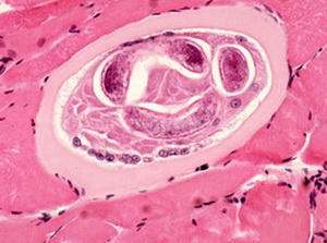 Trichineloza